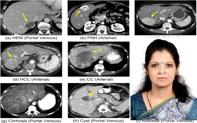 P Vaidehi Nayantara Awarded PhD for Research on Liver Tumor Detection - News Karnataka
