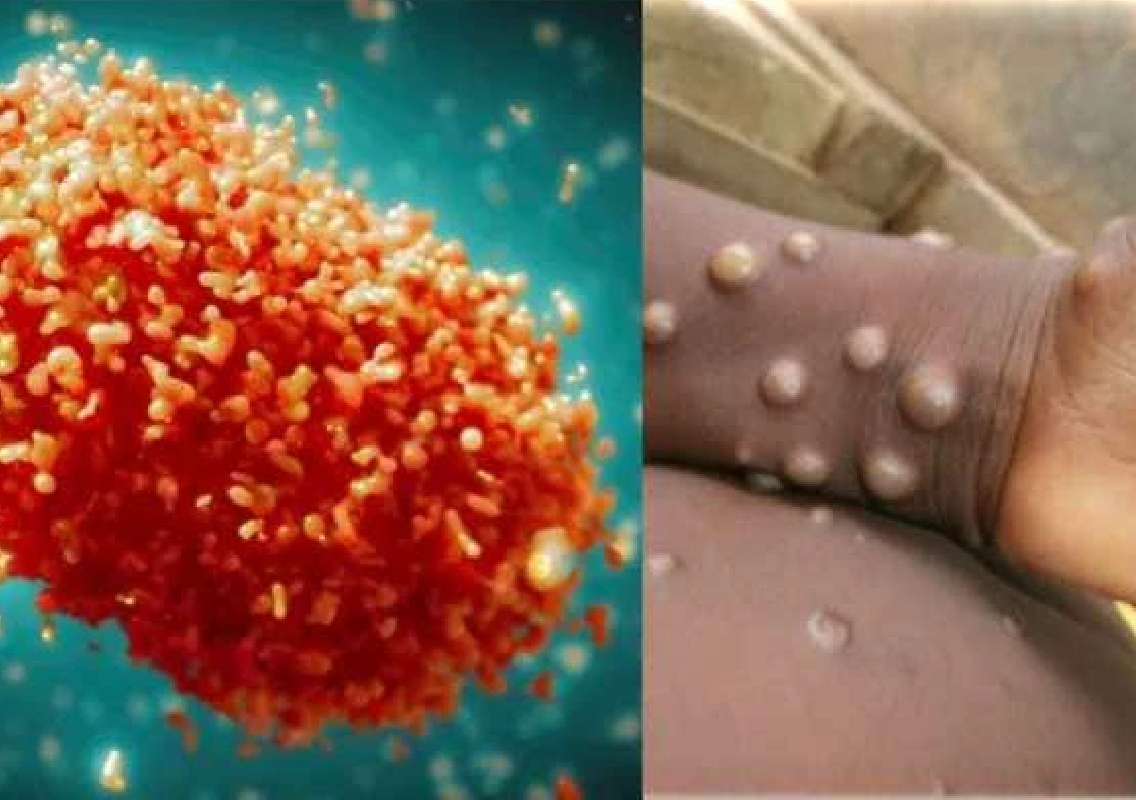 India's Low Mpox Risk Amid Global Health Alert - News Karnataka