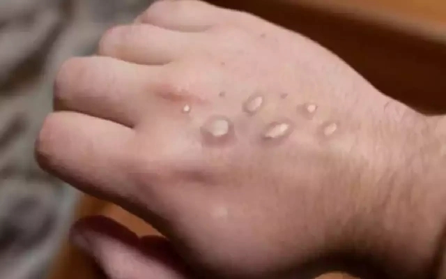 Tamil Nadu Sees a High Risk of Monkey Pox Outbreak - News Karnataka