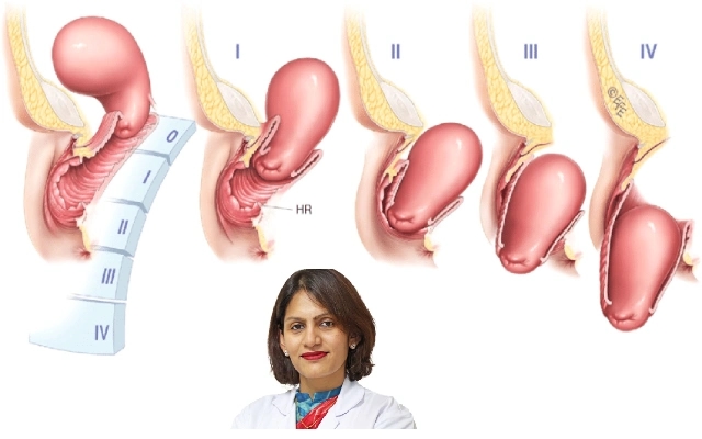 Fortis Hospital Cunningham Road Successfully Treats Stage 3 Uterine Prolapse - News Karnataka