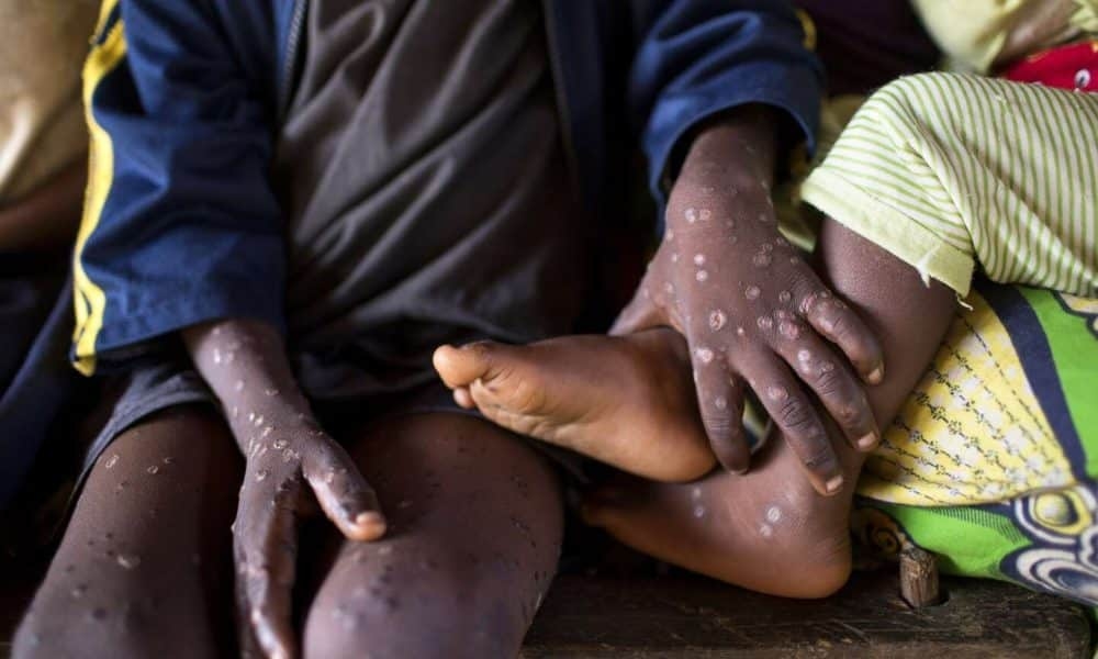 Africa Faces Surge in Mpox Cases Amid Vaccine Delays - News Karnataka