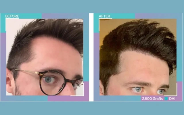 Hair Transplants for Men: A Guide to Restoring Your Hairline - News Karnataka