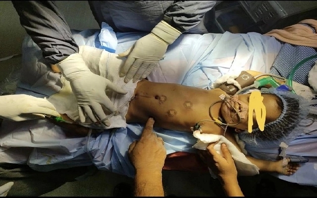 Hyderabad Doctors Perform Rare Kidney Surgery on Infant Using Made-in-India Robotic Machine - News Karnataka