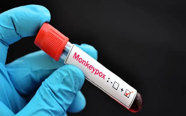 Mangaluru Reports First Monkeypox Case in 2025 - News Karnataka