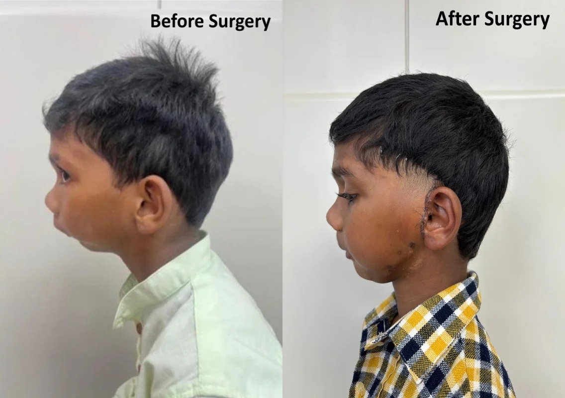 A new smile, a new life: Jaw surgery helps 5-year-old regain his childhood at KMC Hospital - News Karnataka