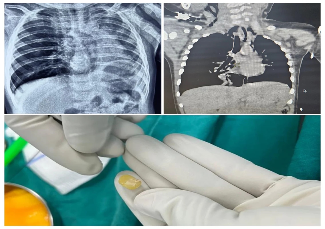 KMC Hospital Mangaluru saves 10-month-old with life-threatening airway blockage - News Karnataka