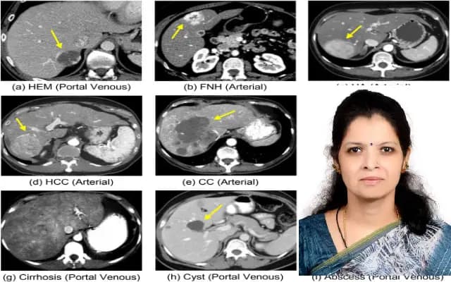 P Vaidehi Nayantara Awarded PhD for Research on Liver Tumor Detection