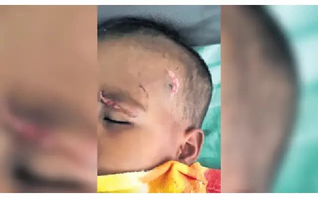 Stray Dog Bites Eight, Including Four Children, in Krishnagiri