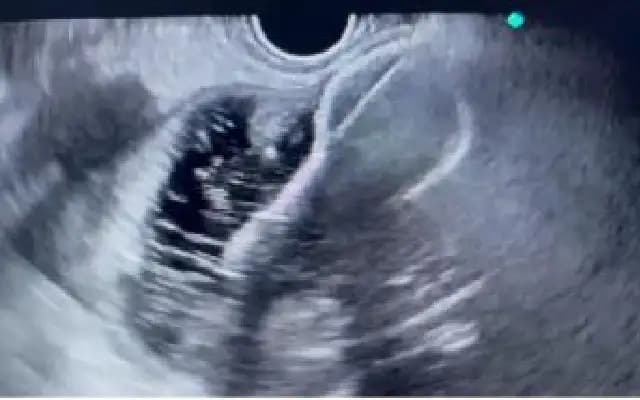 Kasturba Hospital Manipal Achieves Milestone with Innovative Endoscopic Procedure