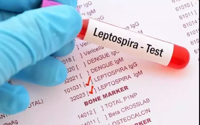 Parkala Resident Dies from Leptospirosis Complications