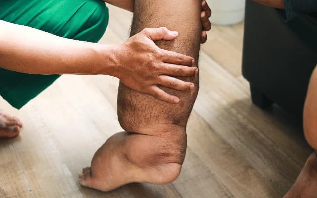 Union Health Ministry Launches Second Phase of Lymphatic Filariasis Elimination