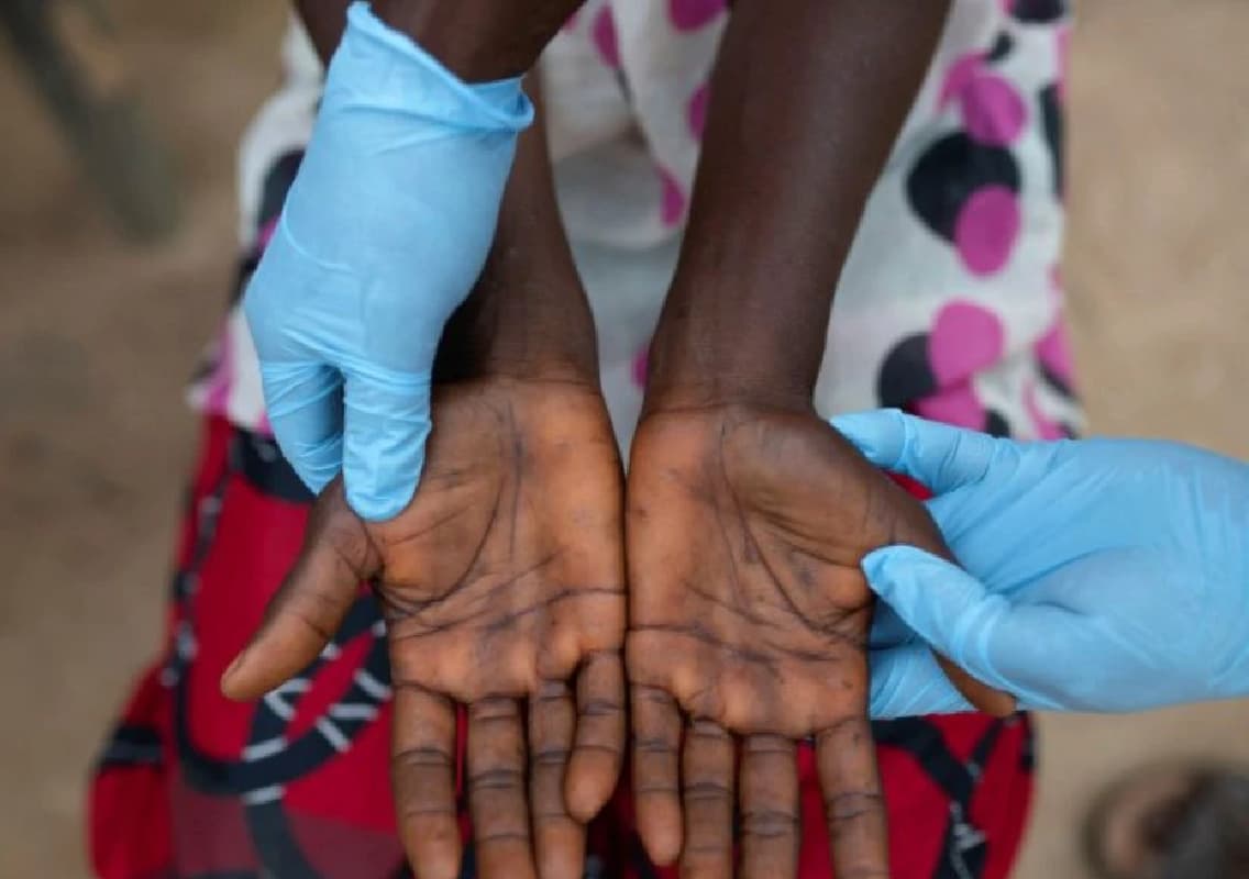 Delhi Hospitals Set Up Isolation Rooms for Mpox