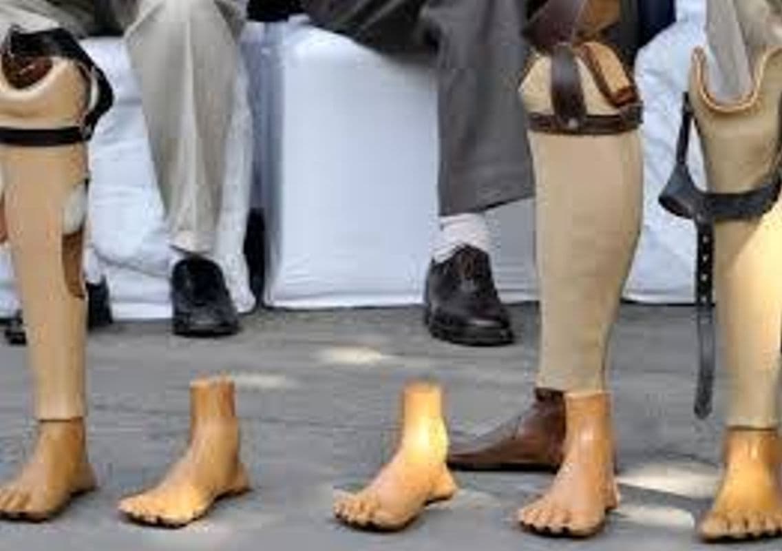 Hospet Hosts Free Jaipur Artificial Leg Fitting Camp