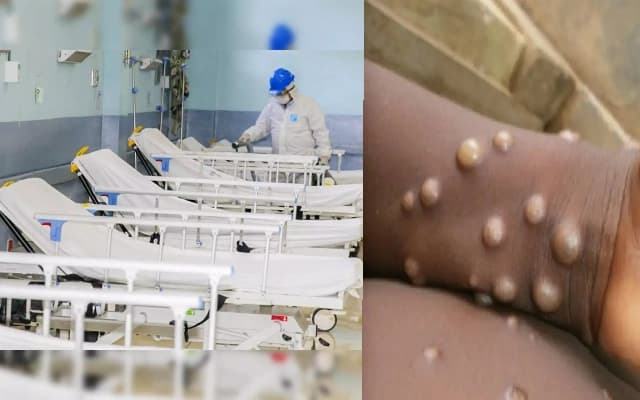 Bengaluru Establishes 50-Bed Isolation Ward for Mpox Containment