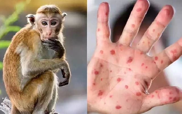 Dakshina Kannada Implements Vigilant Measures Against Monkey Fever