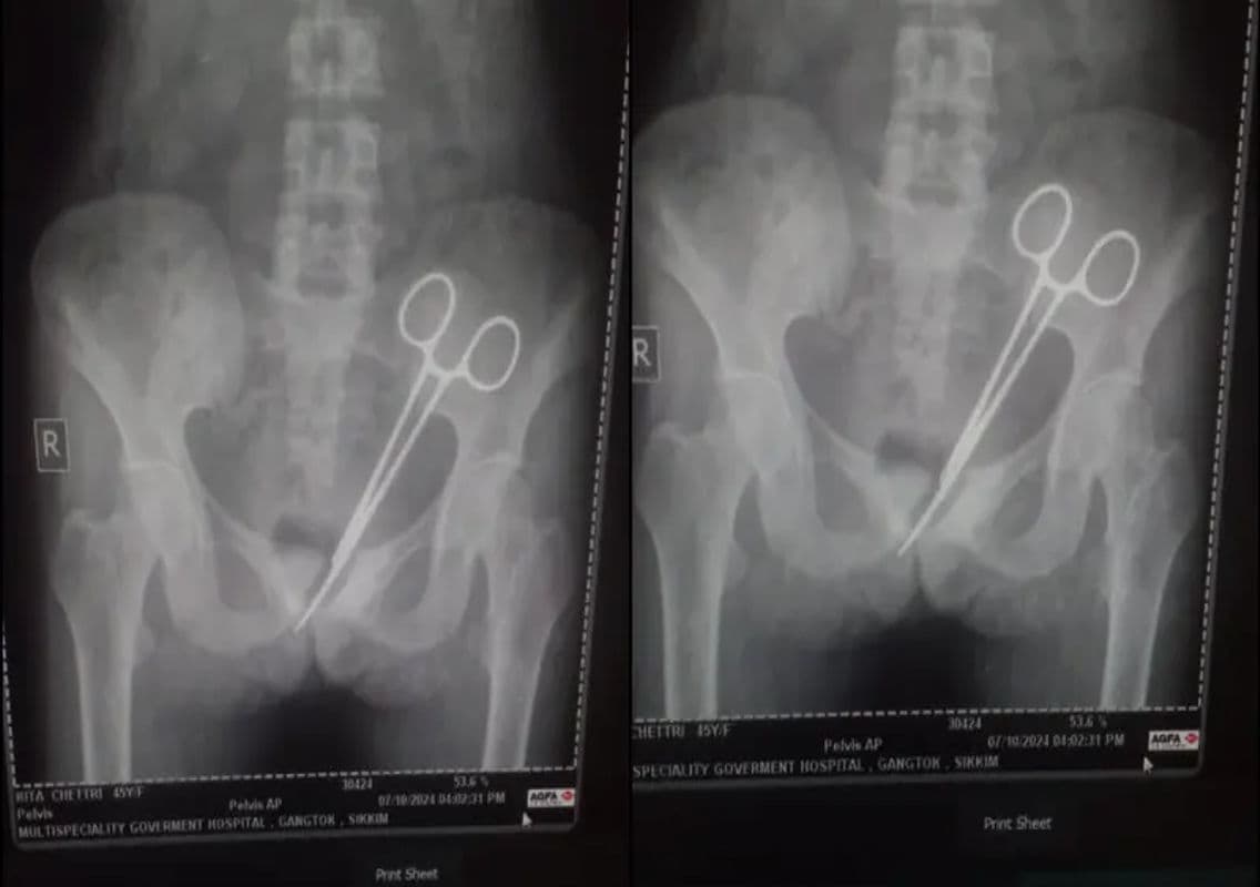 Sikkim Woman Discovers Surgical Scissors in Abdomen 12 Years Post-Surgery