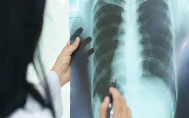 Mandya district achieves significant milestone in reducing TB cases