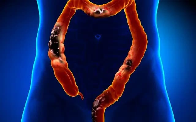 Rising incidence of early-onset bowel cancer: a global concern