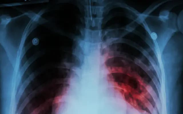Over 40% of Indians Carry TB Bacteria, Expert Warns