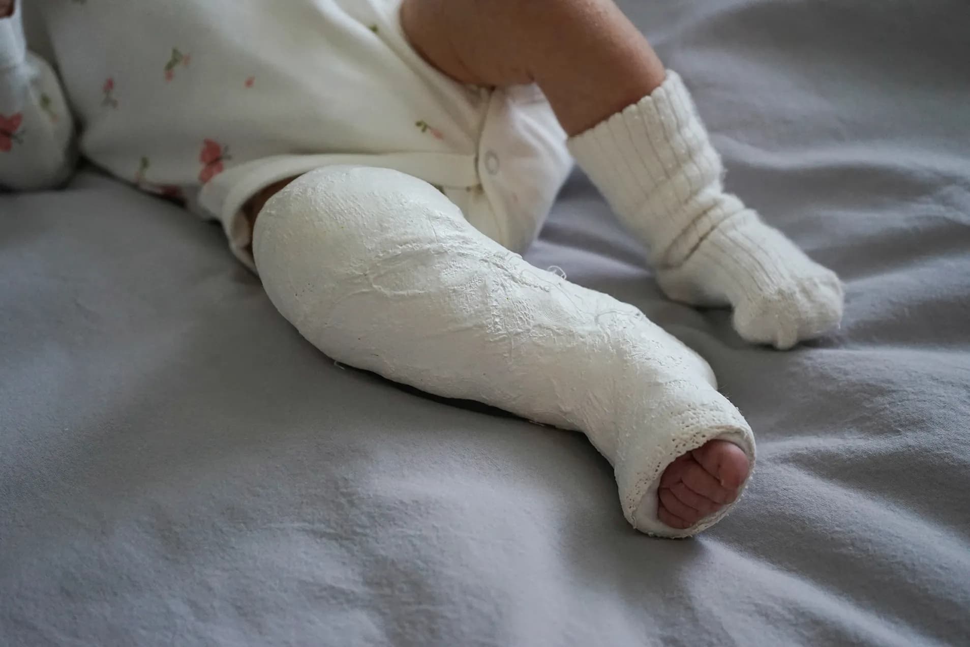 Clubfoot clinic reopens in Kasaragod to offer renewed hope for children