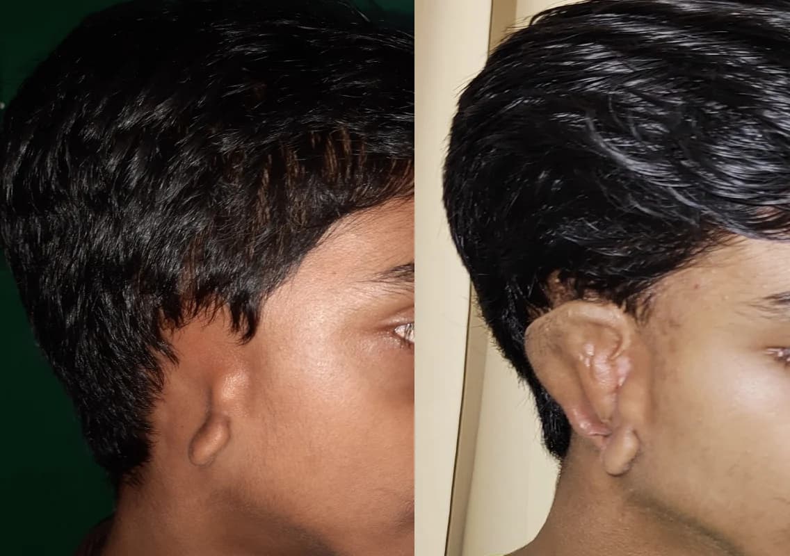 Father Muller Medical College Hospital rebuilds ear of 13-year-old
