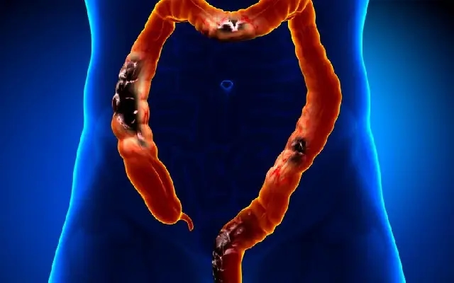 Rising incidence of early-onset bowel cancer: a global concern - News Karnataka