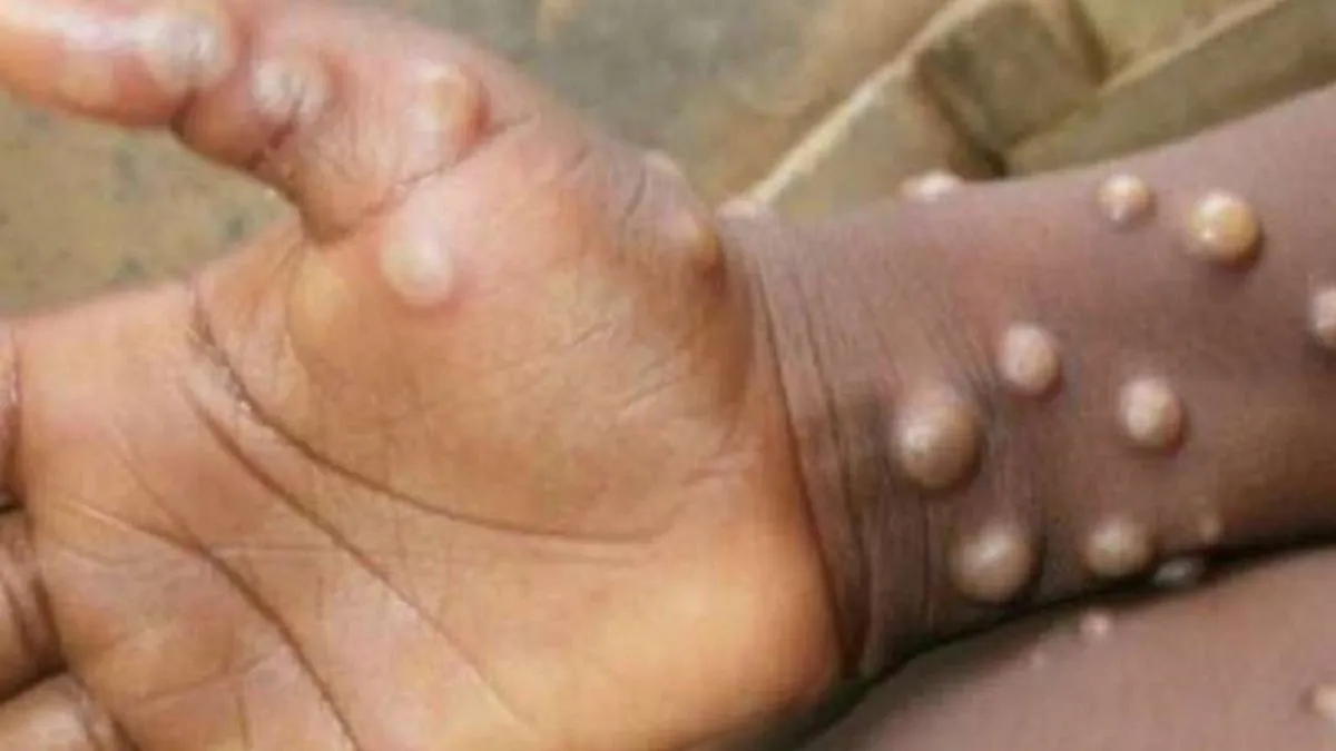 Vigilance high despite no new monkeypox cases in mangaluru - News Karnataka