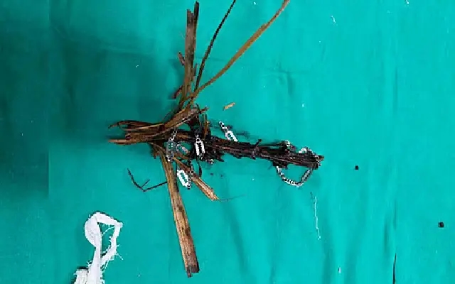 Doctors at Wenlock Hospital Save 12-Year-Old with Complex Surgery - News Karnataka