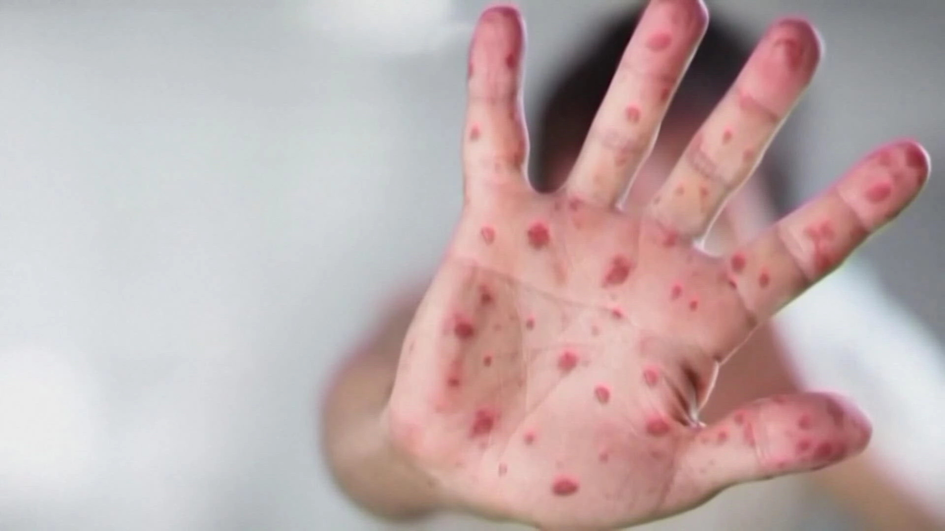 Texas parents reject vaccines after measles claims daughter’s life - News Karnataka