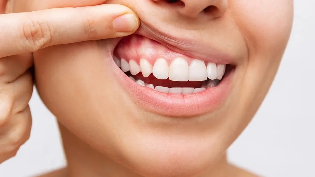 Bad gums, bad days: Study links poor oral health to chronic pain in women - News Karnataka