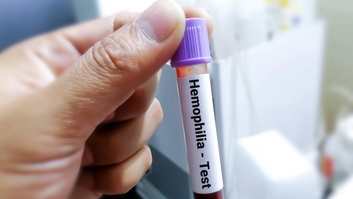 India's first human gene therapy trial for haemophilia takes place in Bengaluru - News Karnataka