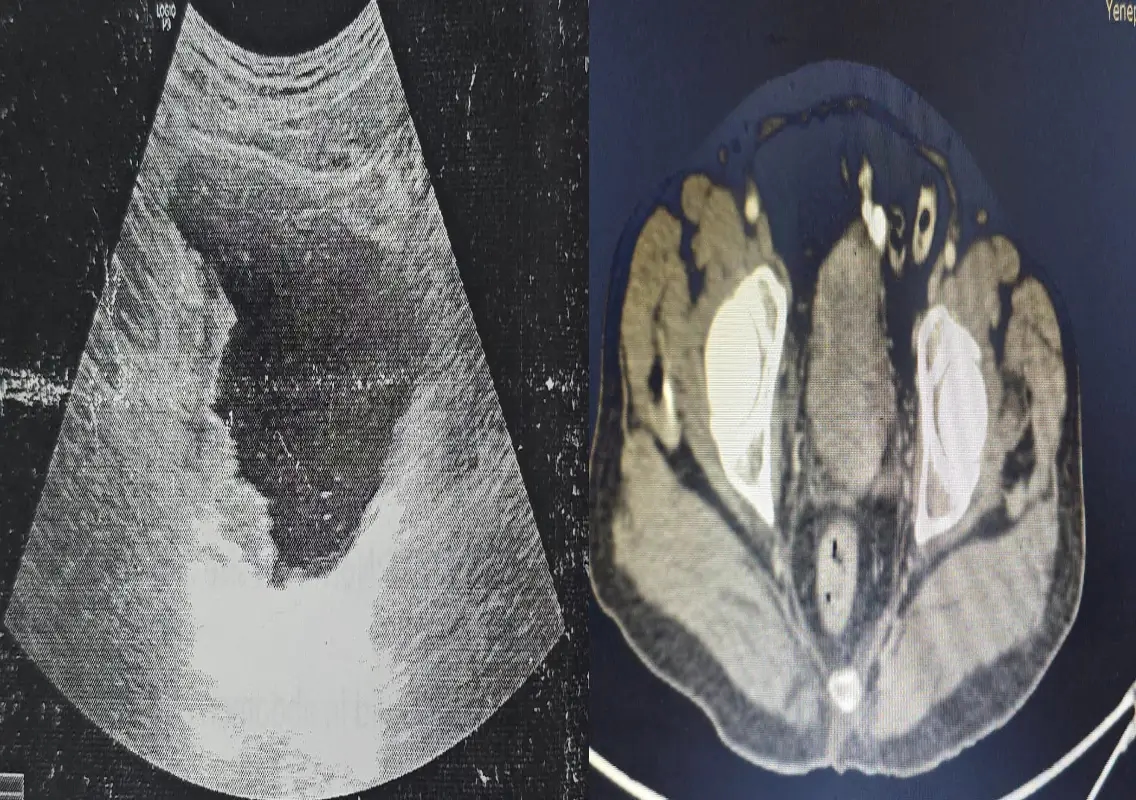 Robotic bladder surgery milestone at Yenepoya offers new hope for cancer patients - News Karnataka