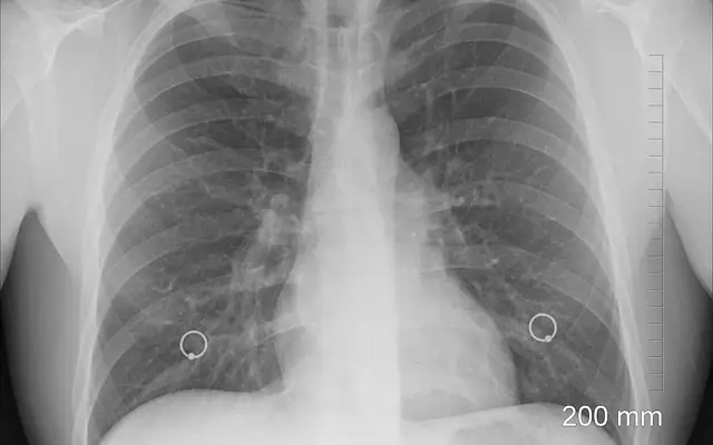Lung cancer no longer a smoker’s disease: Fit, young women share shocking diagnoses - News Karnataka