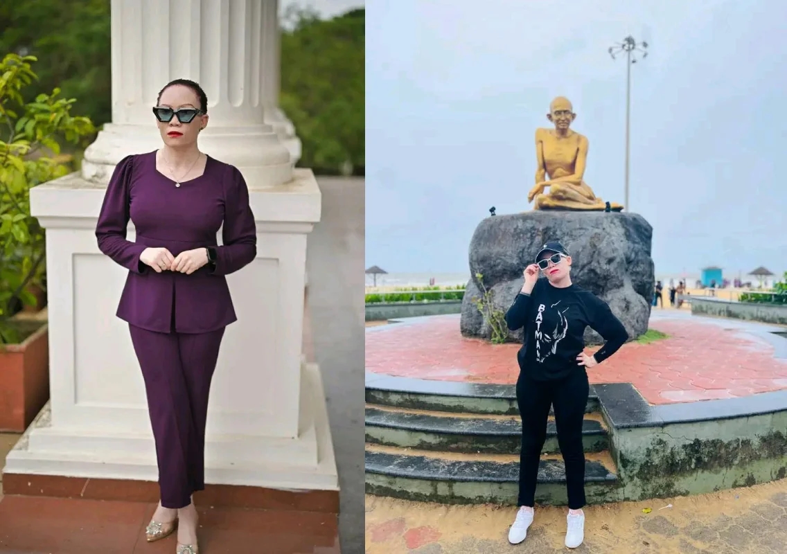 The Delicate Balance: Thriving with Albinism in a Foreign Land - News Karnataka