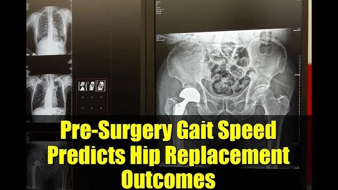 Study finds preoperative walking speed can predict outcomes after hip replacement - News Karnataka