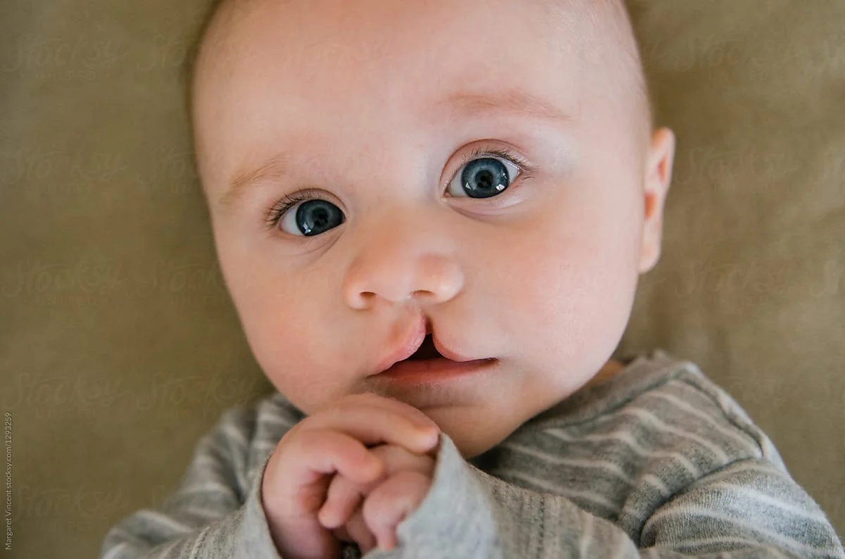 UK mum’s TikTok on cleft diagnosis sparks powerful message of hope - News Karnataka