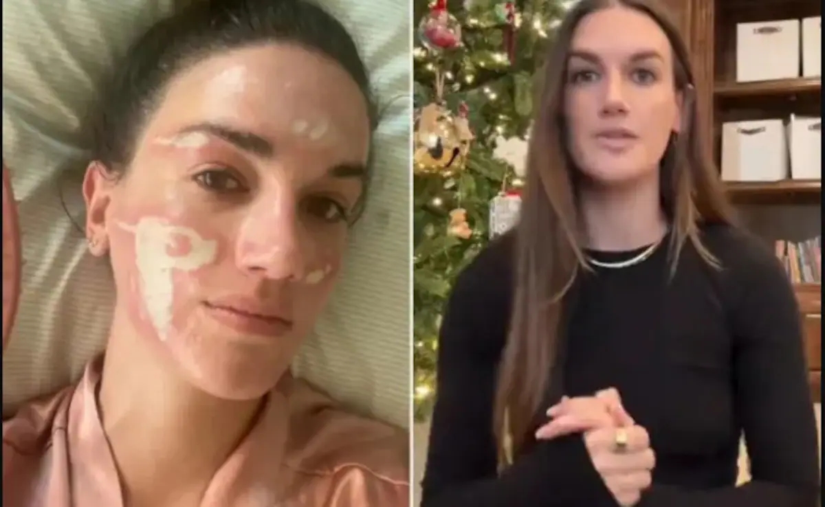 Woman sues celebrity facialist over chemical peel scars - News Karnataka