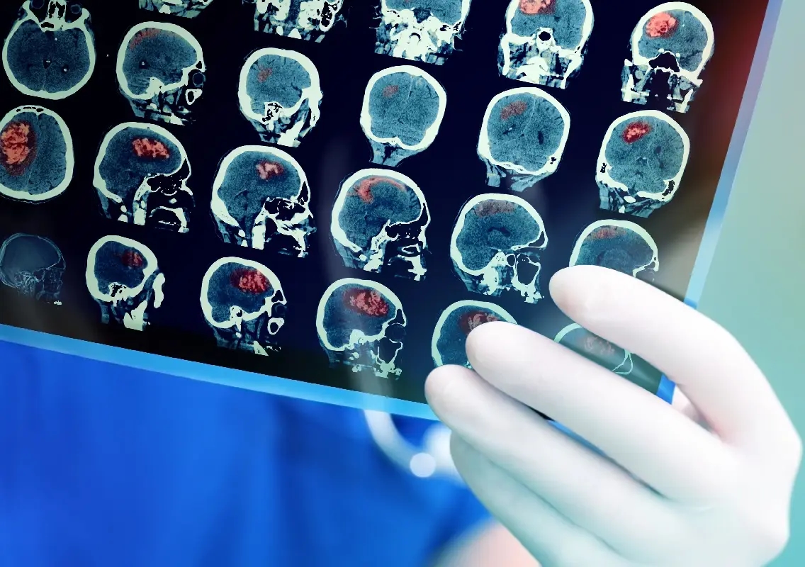 Takeaway order leads to shock diagnosis of aggressive brain tumour - News Karnataka