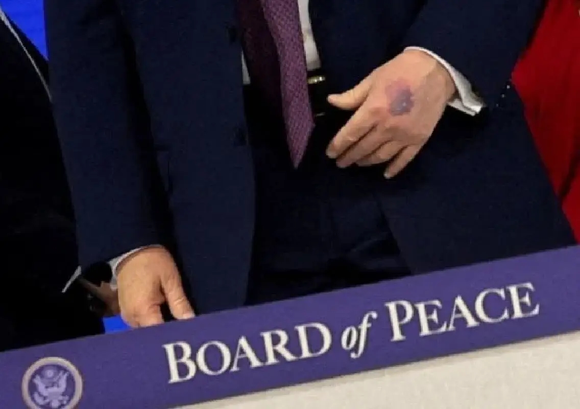 Trump’s hand mark at Davos sparks health talk, White House clarifies - News Karnataka