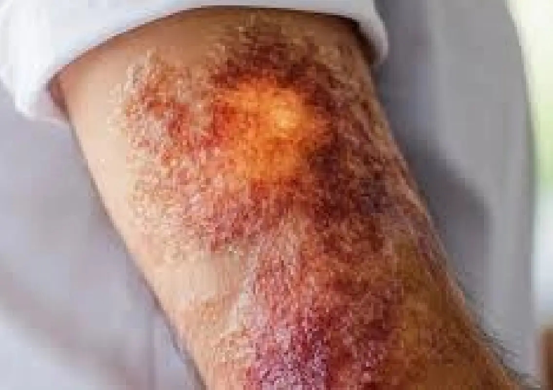 10-year-old with 86% burns survives after critical care - News Karnataka