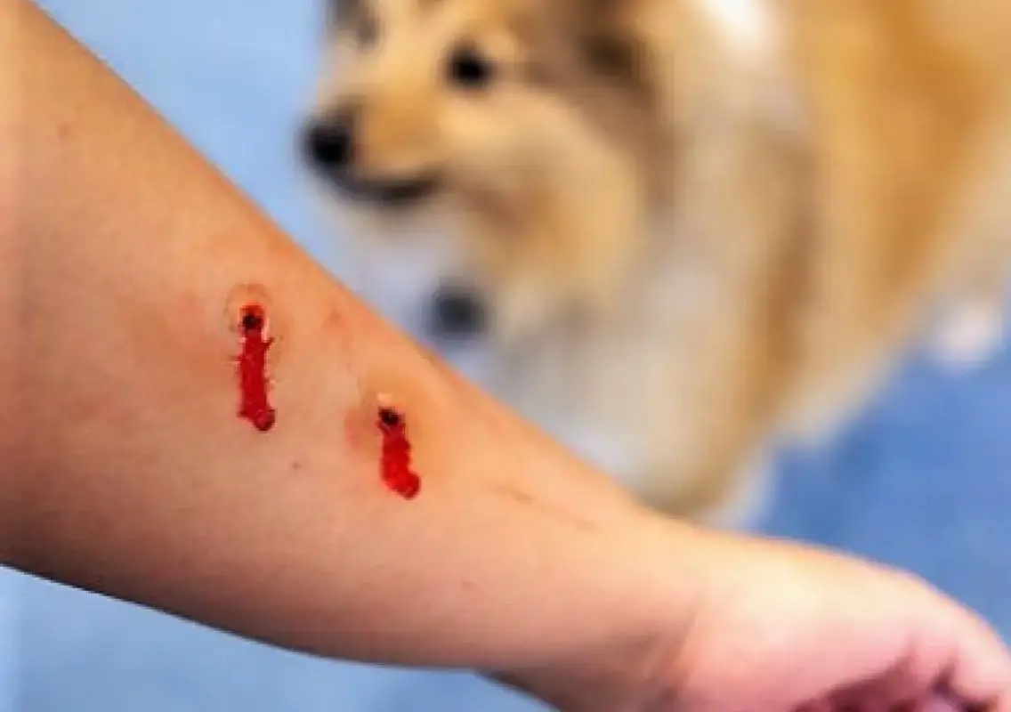Bengaluru dog attack survivor battles trauma as family seeks accountability - News Karnataka