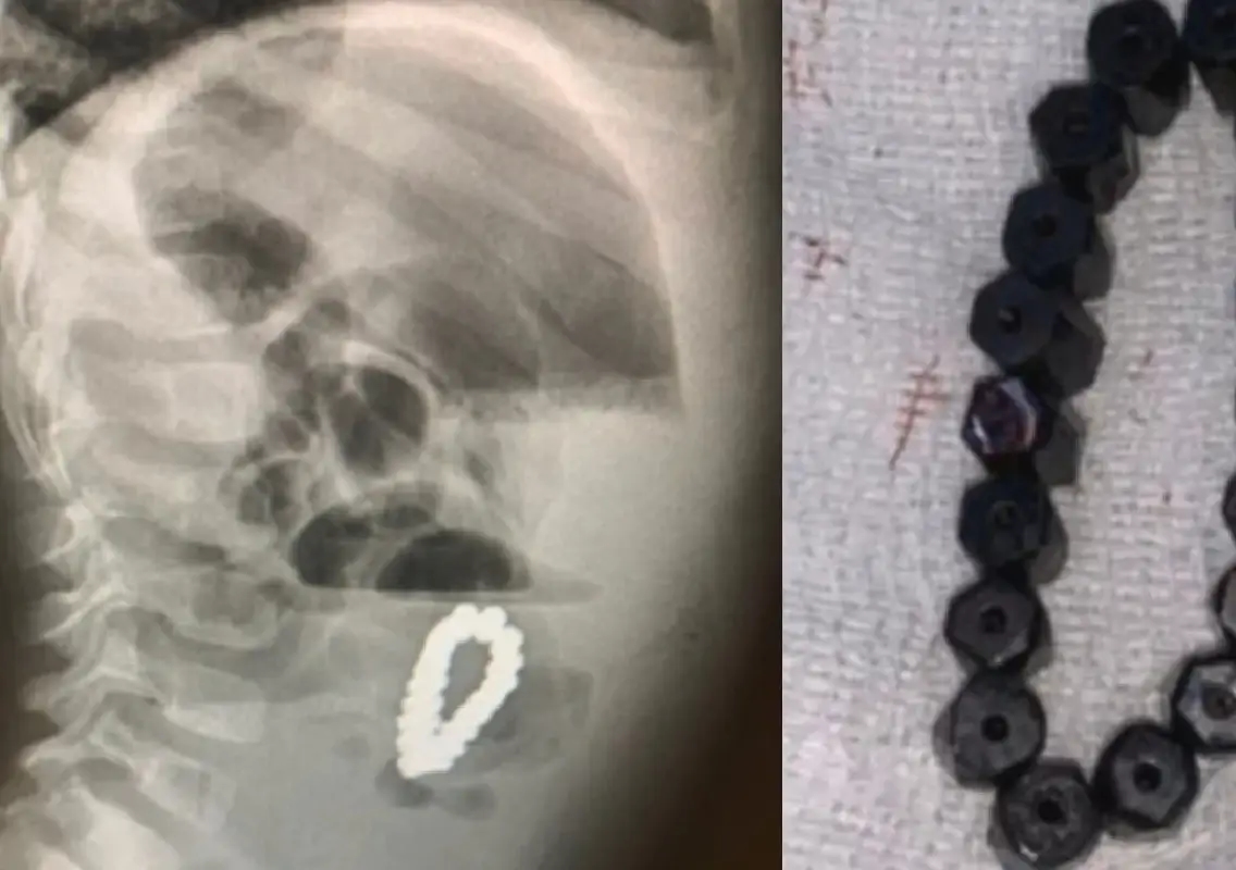 Class I girl dies after swallowing bracelet bead - News Karnataka