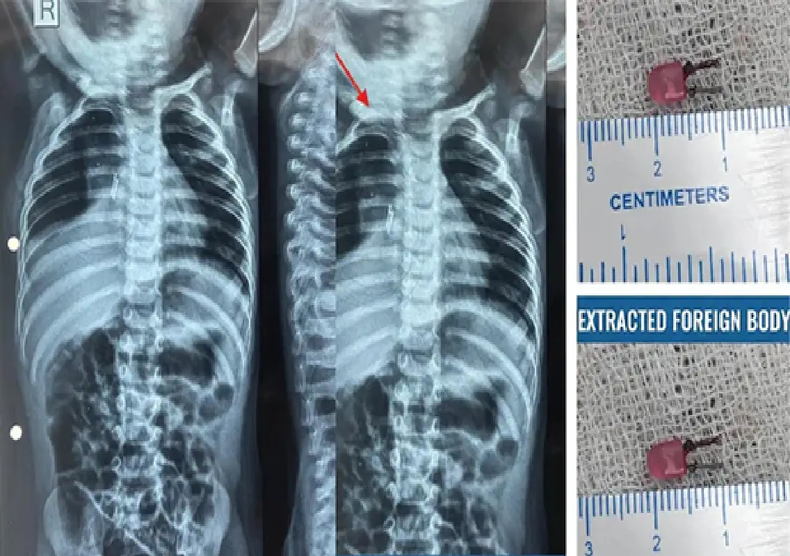 LED bulb removed from toddler’s windpipe after weeks of misdiagnosis - News Karnataka