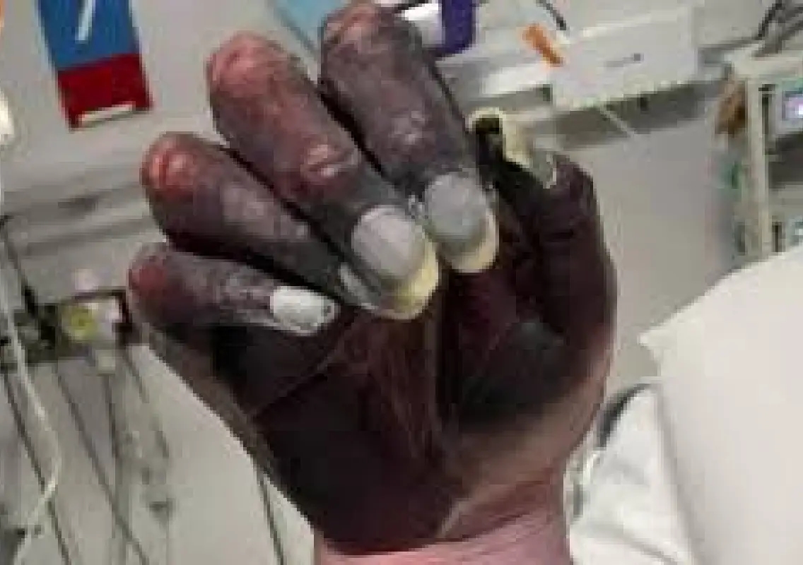 Mother dies after arm amputation as hand discolouration was dismissed - News Karnataka