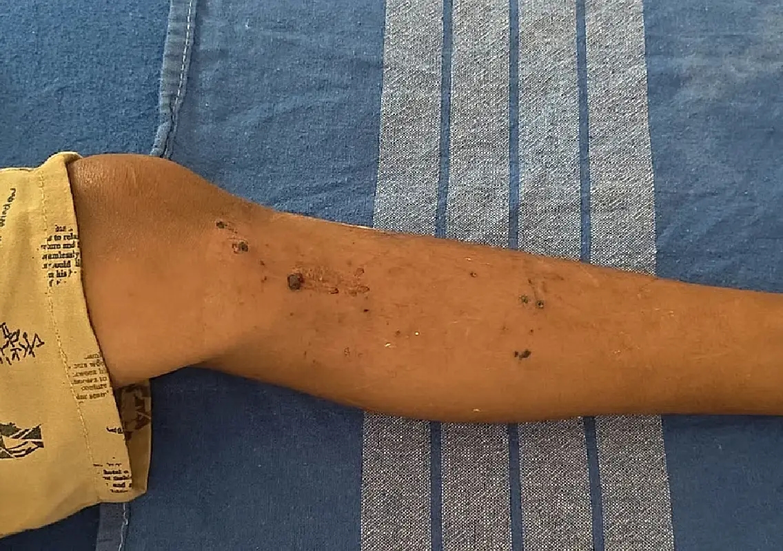 Mystery object explodes during children’s play, boy injured - News Karnataka