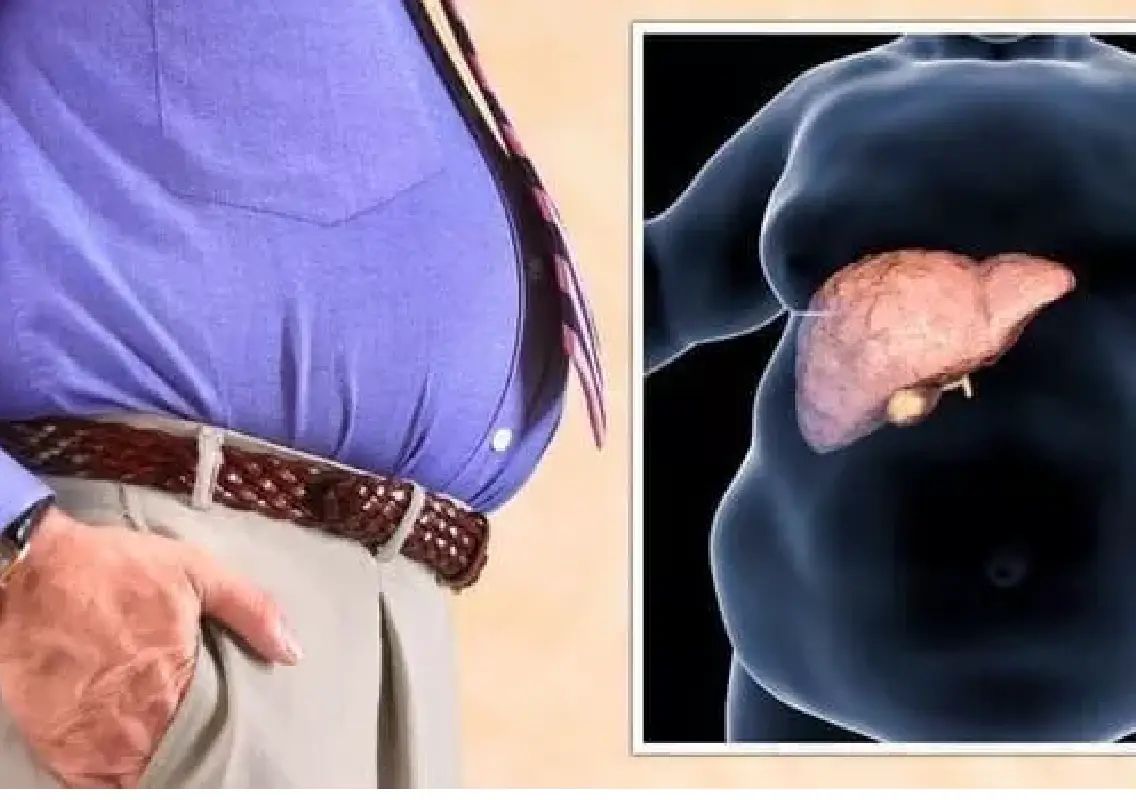 Nearly 41% adults in Hyderabad living with fatty liver - News Karnataka