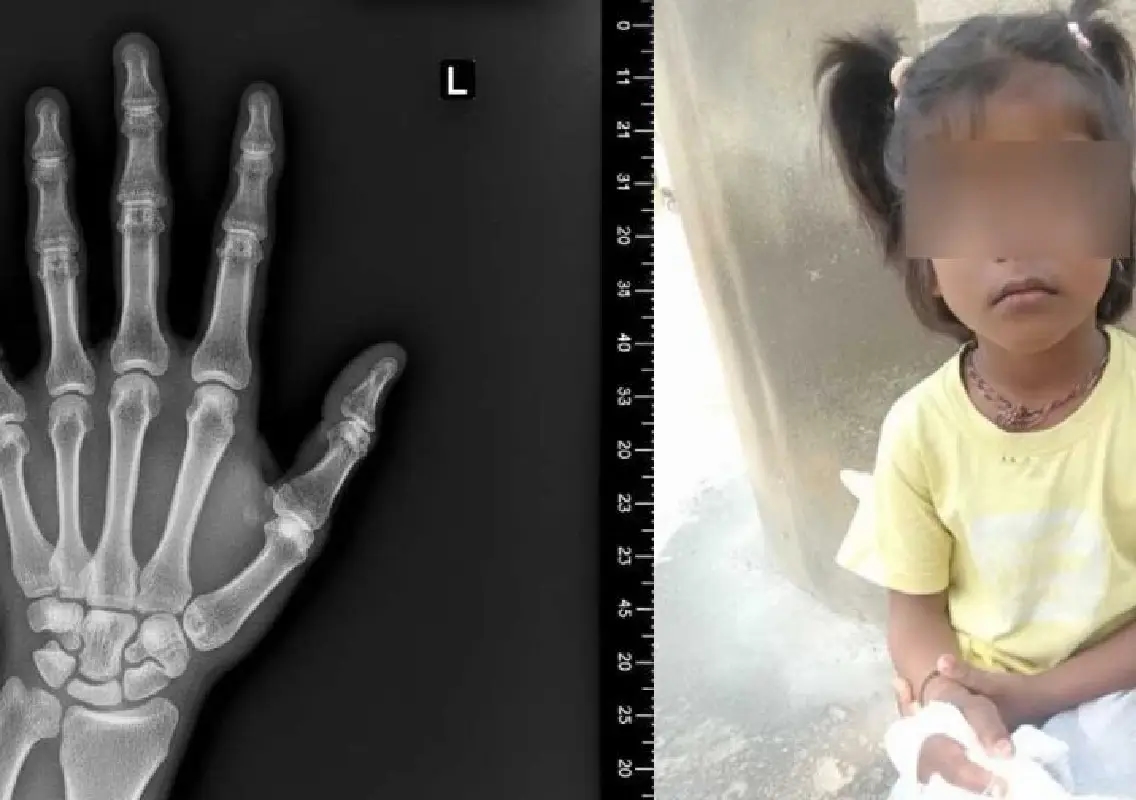 Six-year-old loses fingers in school door tragedy - News Karnataka