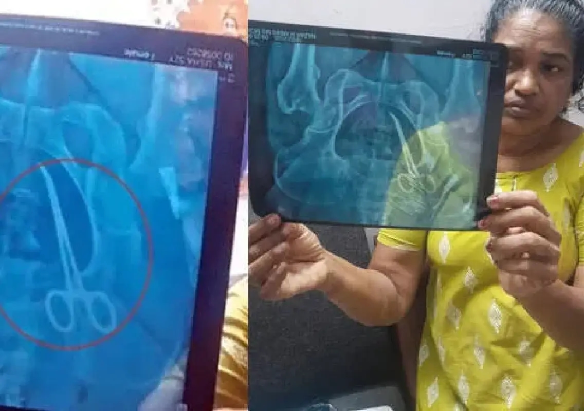 Surgical scissors found in woman’s abdomen five years later - News Karnataka