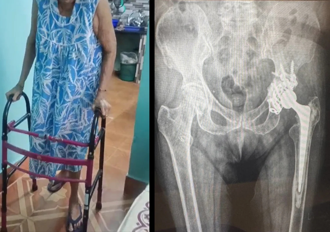 90-year-old woman walks again after complex hip surgery at KMC Attavar - News Karnataka