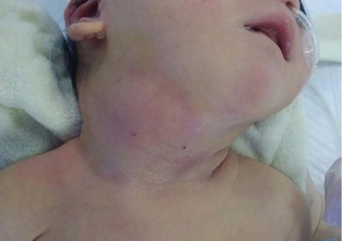 Rare neck swelling in infant diagnosed without surgery using imaging - News Karnataka